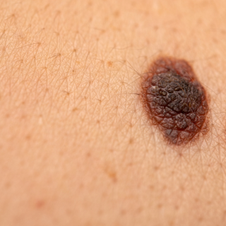 2025 EDW Multidisciplinary General/GI/Melanoma Tumor Board (RSS) Banner